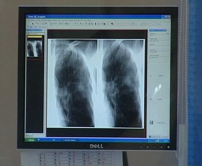 Растет число заболевших туберкулезом