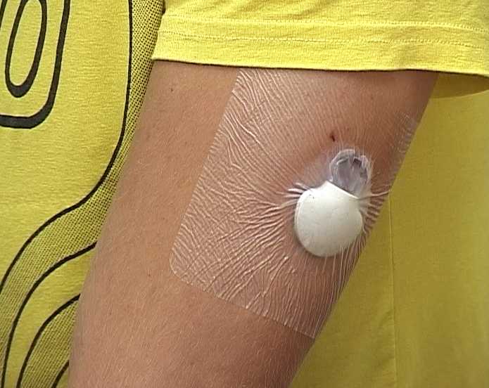 Инсулиновая помпа