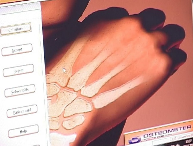 День борьбы с остеопорозом