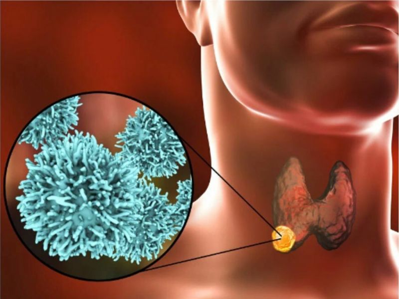 Онколог назвала признаки рака щитовидной железы