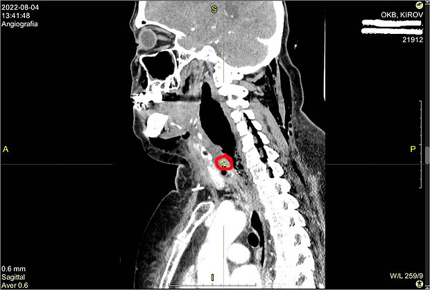 Врачи Кировской больницы спасли пенсионерку с застрявшей в горле рыбной костью