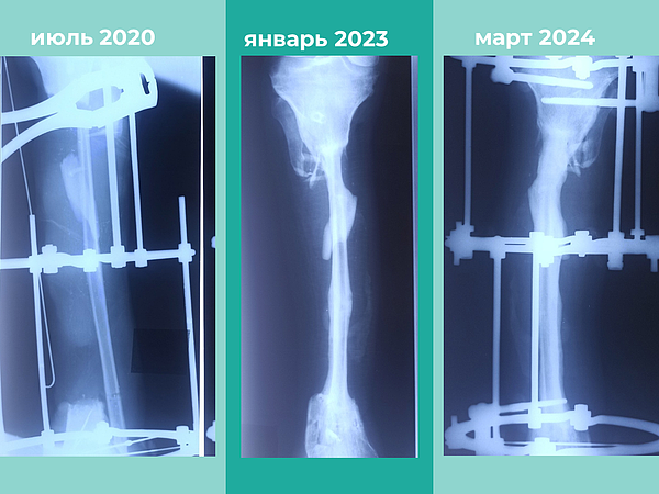 Кировские травматологи провели 17 операций для спасения пациента от ампутации ноги