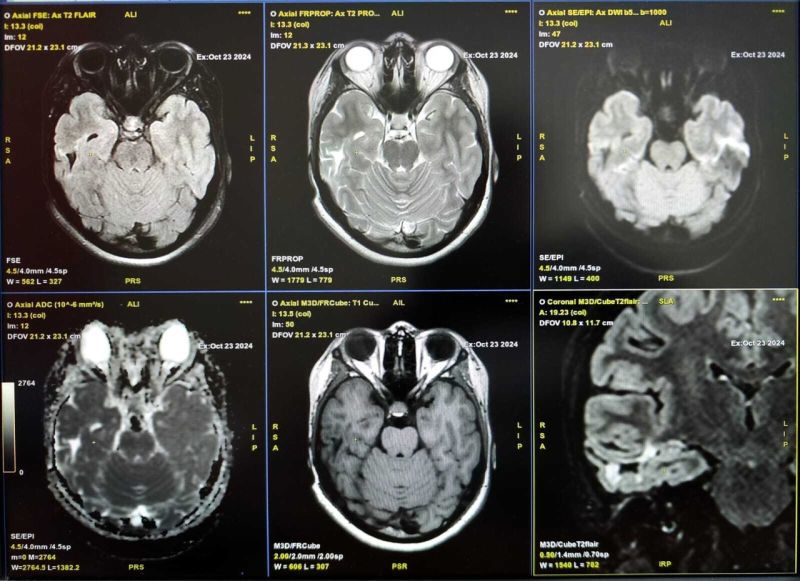 Кировские врачи спасли жизнь девочке, удалив гнойный абсцесс