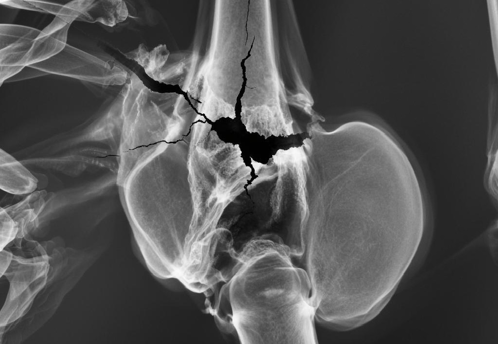 Китайские ученые изобрели «суперклей», помогающий при переломах костей