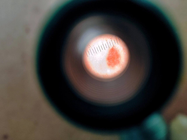 Кировчане смогут бесплатно обследовать свои родинки в выходной день